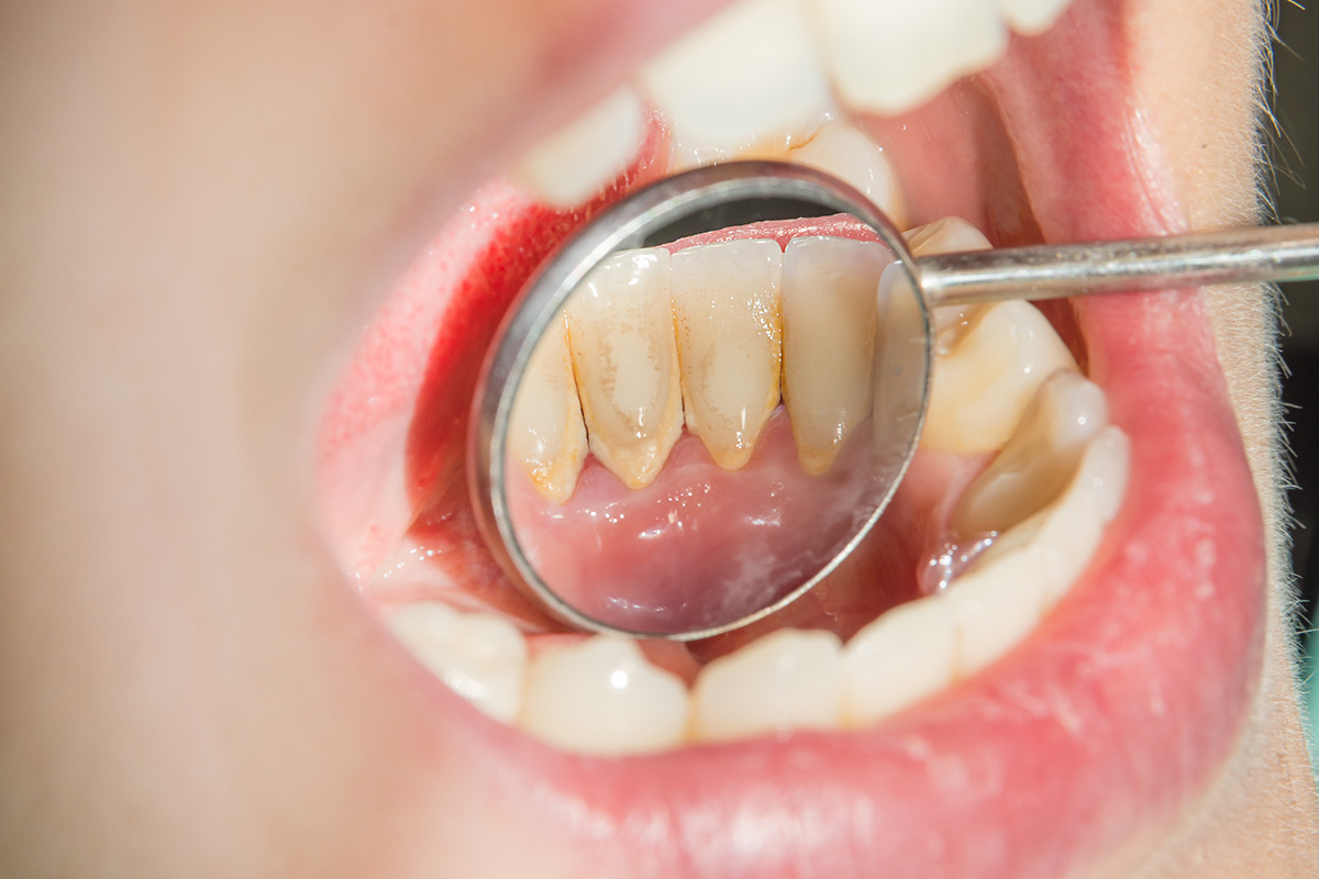 Cuál es el mejor remedio casero para eliminar el sarro de los dientes?