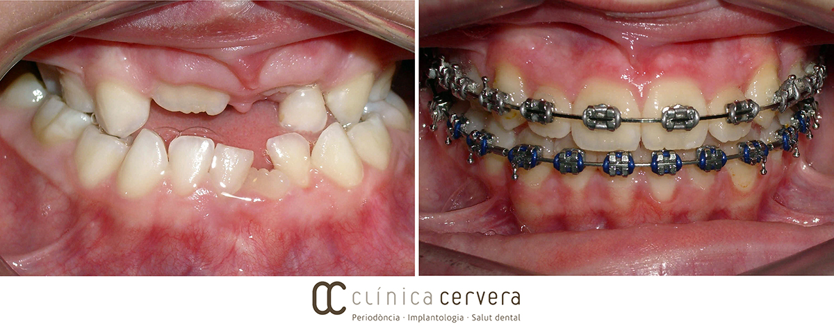 Orthodontic cases in crossbites