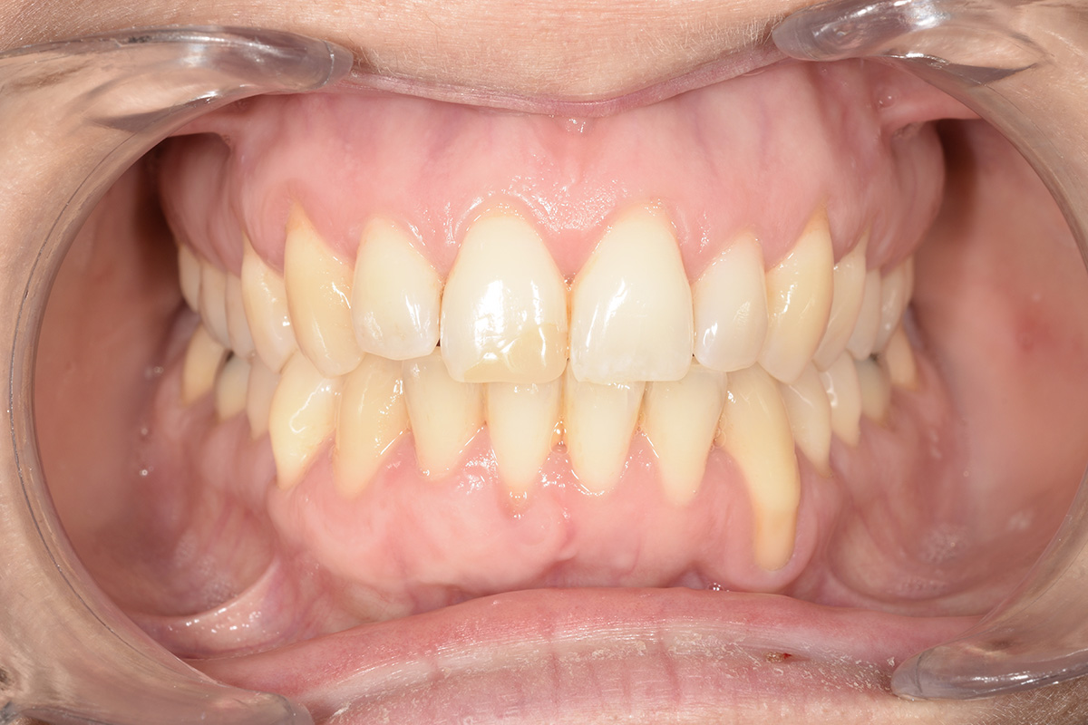 Receding gums