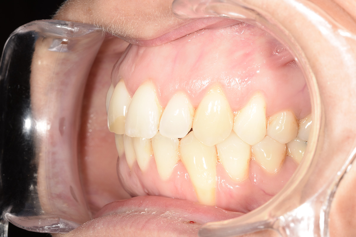 Receding gums
