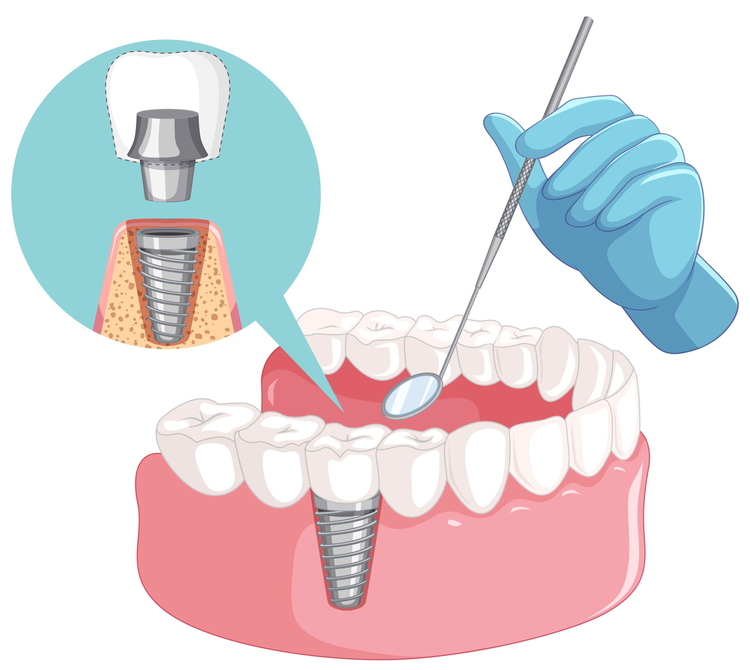 Implant dental
