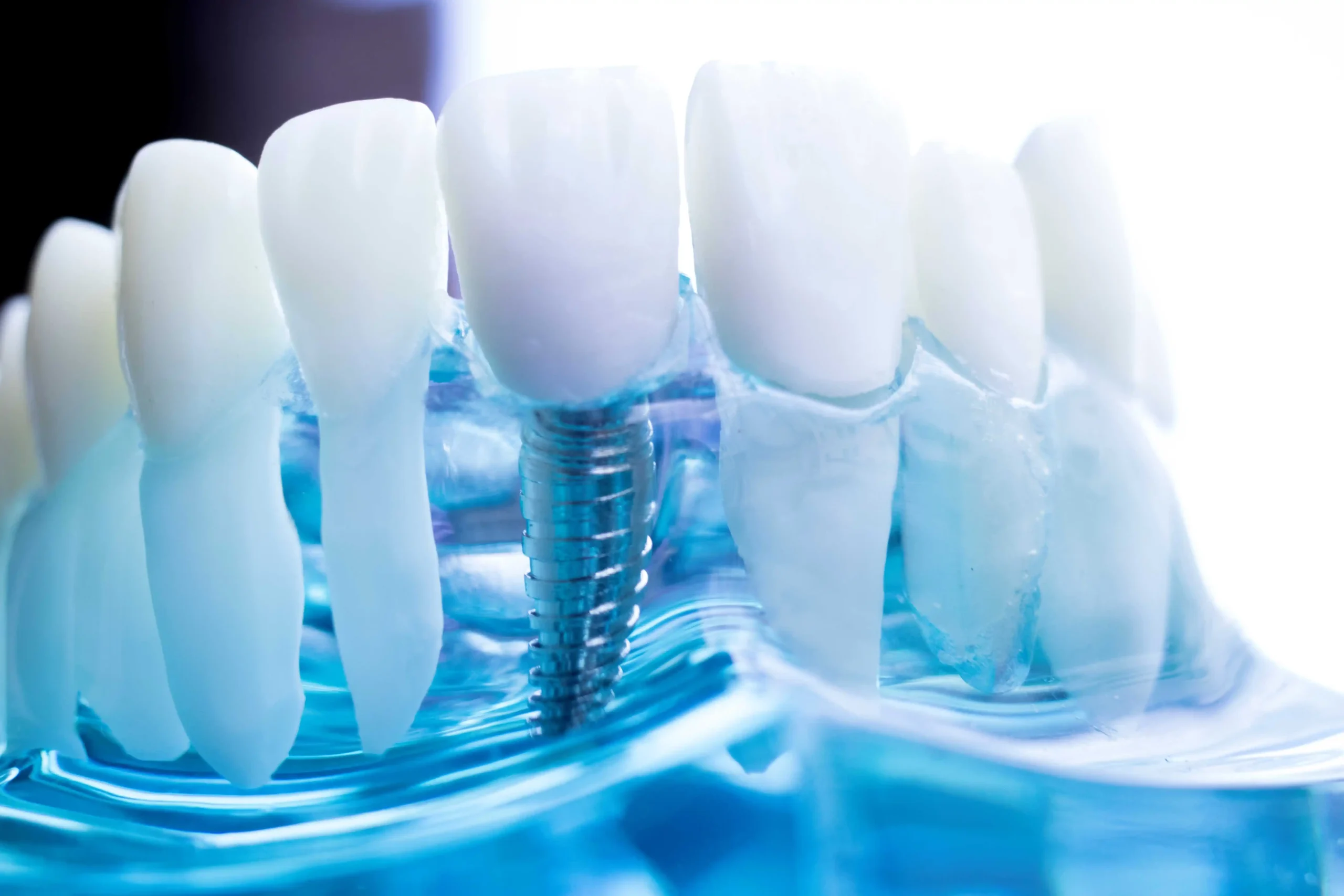 Implant dental